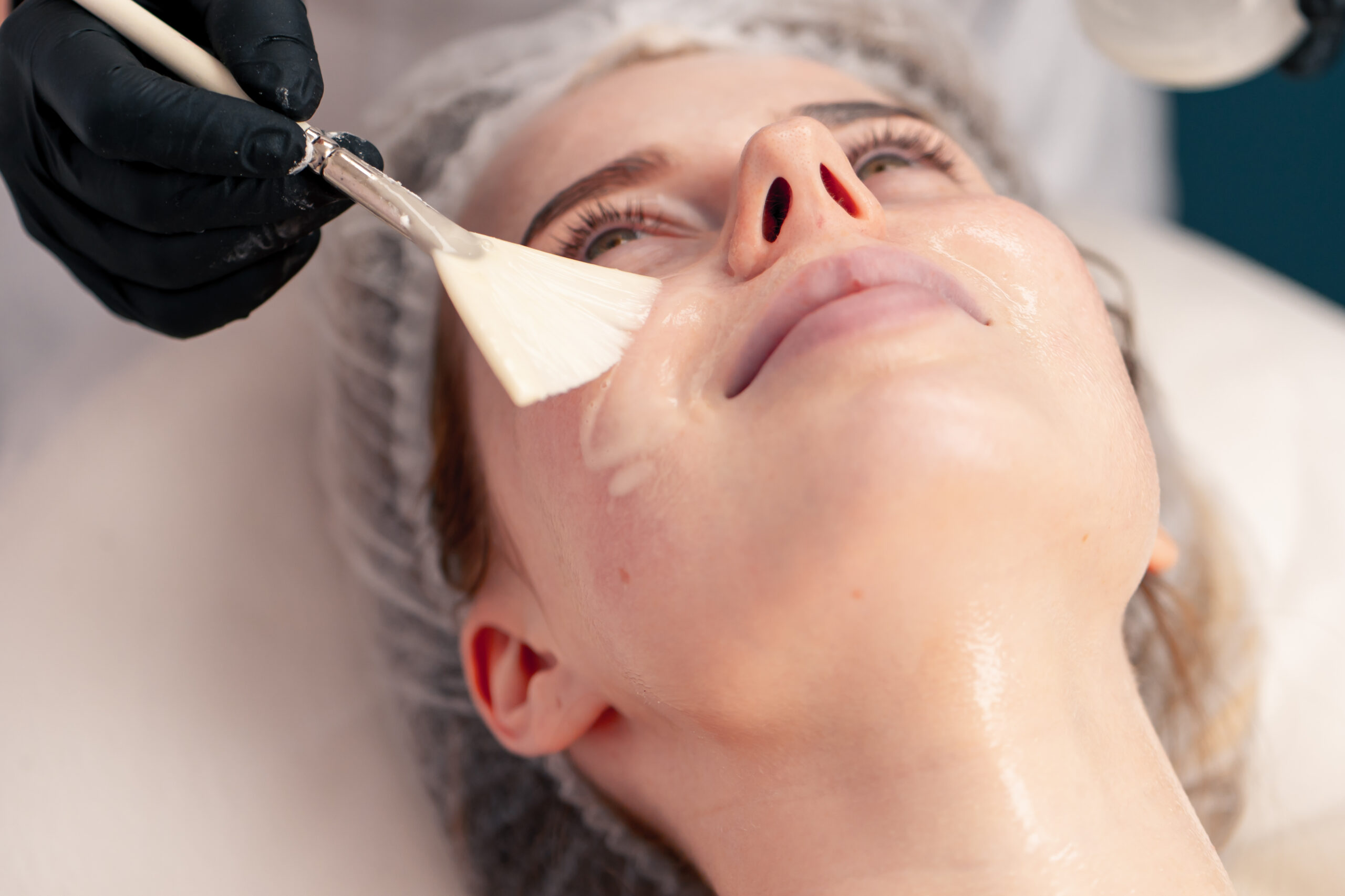 Chemical Peels