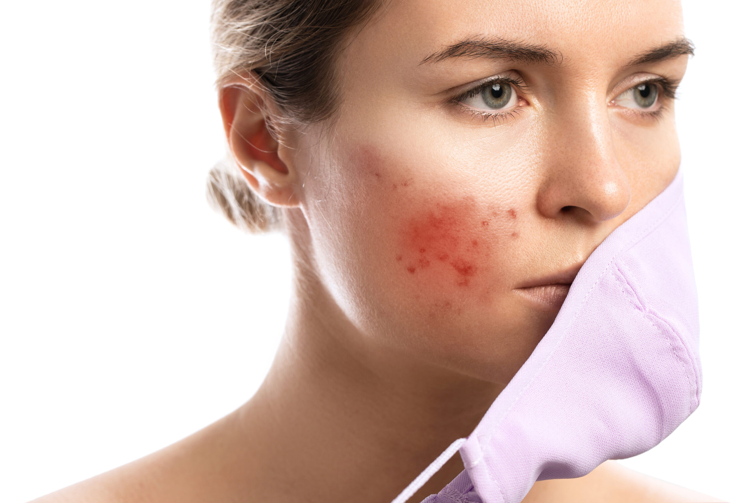 acne and rosacea Acne/ Rosacea Treatment